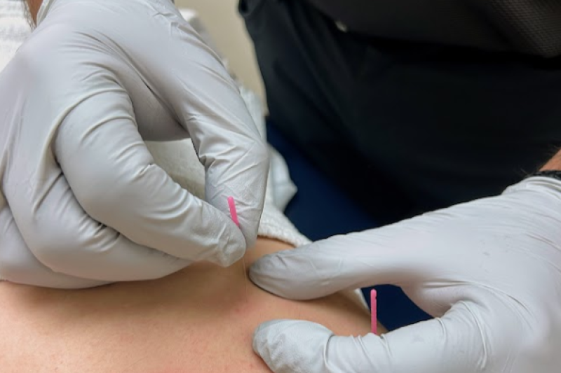 dry needling procedure