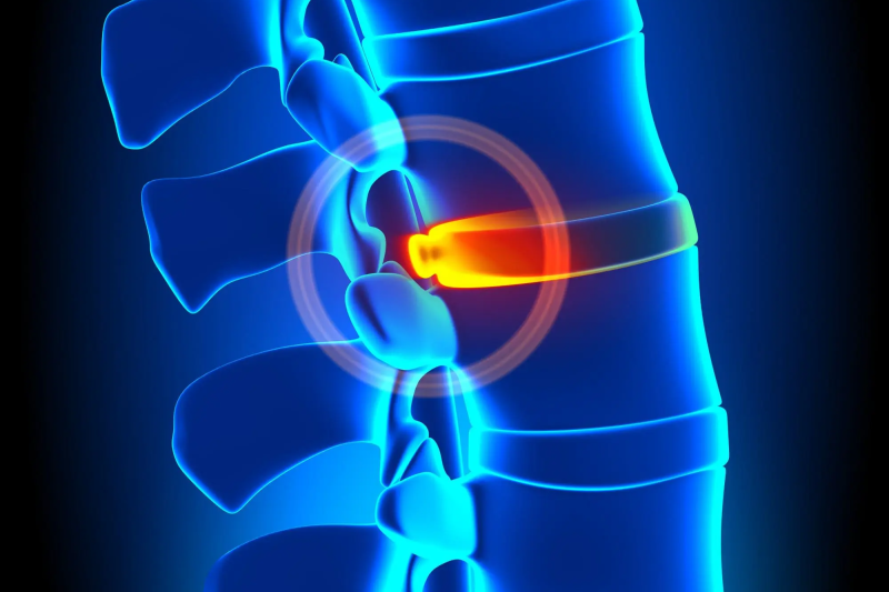 Lumbar disc herniation low back pain